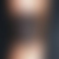 Naevus pigmentosus et pilosus. Seit Geburt bestehende, stark pigmentierte, in den letzten Jahren ...