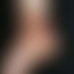 Naevus pigmentosus et pilosus. Angeborene (permanente), scharf begrenzte, hellbraune, oftmals zen...
