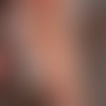 Naevus sebaceus: bizarr konfigurierte, zur gesunden Haut scharf begrenzte, asymptomatische, haarl...
