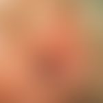 Naevus sebaceus: Entwicklungen unterschiedlicher Tumorformationen in einem Naevus sebaceus bei ei...