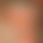 Naevus sebaceus: Seit Geburt bestehender haarloser Fleck (Plaque) im Bereich des Kapillitiums ein...
