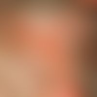 Naevus sebaceus: Seit Geburt bestehender haarloser Fleck (Plaque) im Bereich des Kapillitiums ein...