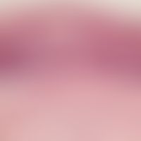 Nevus sebaceus: Detail enlargement: Basal cell carcinoma with typical, artificial cleft formation...