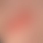 Naevus sebaceus: Seit Geburt bestehende, 1,8 x 3,2 cm messende, gering erhabene, leicht zunehmend...