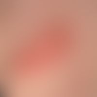 Naevus sebaceus: Seit Geburt bestehende, 1,8 x 3,2 cm messende, gering erhabene, leicht zunehmend...