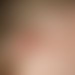 Naevus sebaceus: Bereits bei Geburt zeigte sich im Nackenbereich ein vollständig symptomloser, bi...