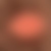 Naevus sebaceus:Hairless, completely symptomless, verrucous plaque in the capillitium of a 25-yea...