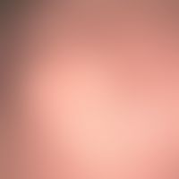 Sebaceous nevus: clinical aspect of a sebaceous nevus in a few-month-old infant; only the slight ...