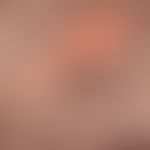 Naevus sebaceus: Ausbildung eines pigmentierten Hidradenom innerhalb des klar abzugrenzenden, haa...
