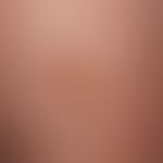 Naevus spilus: Pigmentation spot existing since birth, increasing splatter-like pigmentation in r...