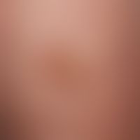 Naevus spilus. Seit Geburt bestehender Pigmentfleck, zunehmende spritzerartige Pigmentierung in d...