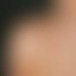 Naevus spilus: Large nevus since birth, increasing splatter-like pigmentation in the following ye...