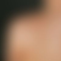 Naevus spilus. Großflächiger Naevus seit Geburt, zunehmende spritzerartige Pigmentfleckbildung in...