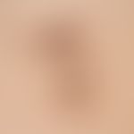 Naevus spilus. general view: multiple, chronically inpatient, spatter-like distributed, dissemina...