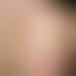 Naevus spilus: Sharply defined, rounded, irregularly shaped, usually up to palm-sized, light brow...