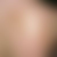 Naevus spilus. Scharf begrenzter, abgerundeter, unregelmäßig geformter, meist bis handtellergroße...