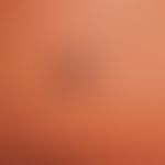 Naevus Spitz: a slightly raised, sharply defined, irregularly pigmented tumour that has existed f...