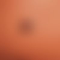 Naevus Spitz: a slightly raised, sharply defined, irregularly pigmented tumour that has existed f...