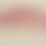 Nevus Spitz: symmetrical melanocytic compound type nevus, sharply defined towards depth.
