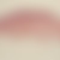 Nevus Spitz: symmetrical melanocytic compound type nevus, sharply defined towards depth.
