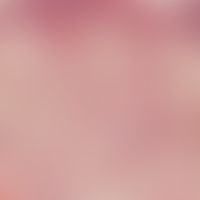 Naevus Spitz: Detail enlargement: Hyperplastic epidermis, pronounced ortho-hyperkeratosis. intrae...