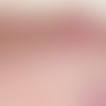 Naevus Spitz: Compound type: Epithelial hyperplasia, irregular pigmentation; large nests with irr...
