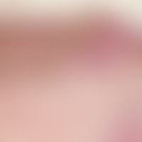 Naevus Spitz: Compound type: Epithelial hyperplasia, irregular pigmentation; large nests with irr...
