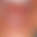 Naevus spongiosus albus mucosae. „Schon immer“ bestehende flächige scharfbegrenzte Leukoplakie im...