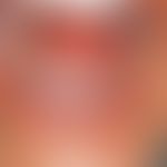 Naevus spongiosus albus mucosae: "Always" existing flat, sharply limited leukoplakia in the vesti...