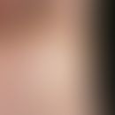 Nevus, striated. striated, verrucous, epidermal nevus with yellow-white, rough, striated horny pl...