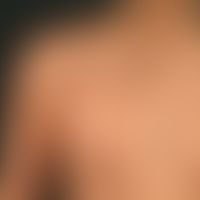Naevus verrucosus unius lateralis: Multiple, chronically inpatient, since birth existing, in rece...