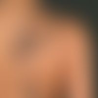 Naevus verrucosus unius lateralis: Multiple, chronically inpatient, since birth, clearly raised, ...
