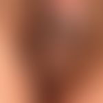 Naevus verrucosus. Detailaufnahme: Seit Geburt bestehende, multiple, braune bis schwarze, flach e...