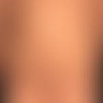 Naevus verrucosus mit Anordnung längs der Blaschko-Linien.
