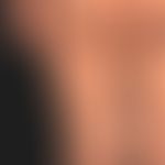 Naevus verrucosus mit Anordnung längs der Blaschko-Linien.
