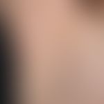 Naevus verrucosus mit Anordnung längs der Blaschko-Linien.
