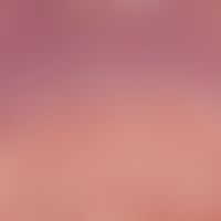 Nevus, melanocytic. Dermal type. Sharply defined melanocytic cell clusters in the deep dermis. Re...