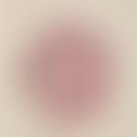 Gewöhnlicher melanozytärer Naevus. Dermaler Typ. Knotige Neubildung mit diffuser Ausbreitung der ...