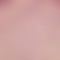 nevus, melanocytic. detail enlargement: melanocytes in the upper dermis in nests, in the middle a...