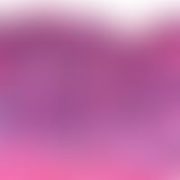 Usual melanocytic nevus, junctional type. detail: irregular elongation of the reteleal ridges wit...