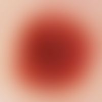 Nevus, melanocytic. reflected-light microscopy: Junction nevus on the lower leg of a 50-year-old ...