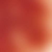 Nevus, melanocytic. reflected light microscopy: Compoundnaevus (section) in the breast area of a ...