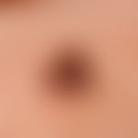 Nevus, melanocytic. type: Acquired dysplastic melanocytic nevus. solitary, chronically inpatient,...