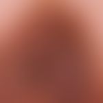 Naevus, melanozytärer. Typ: Erworbener dysplastIscher melanozytärer Naevus.&nbsp; Detailaufnahme:...