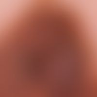 Nevus, melanocytic. type: Acquired dysplastic melanocytic nevus. Detail: The reticular, dark brow...