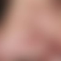 Gewöhnlicher&nbsp;melanozytärer Naevus. Dermaler Typ. Erworbener, seit Jahrzehnten bekannter, sol...