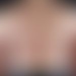 Gewöhnlicher&nbsp;melanozytärer Naevus. Typ: Nicht familiäres Syndrom der (erworbenen)&nbsp;dyspl...
