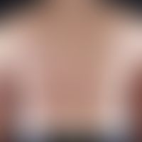 Gewöhnlicher&nbsp;melanozytärer Naevus. Typ: Nicht familiäres Syndrom der (erworbenen)&nbsp;dyspl...
