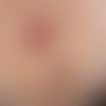 Gewöhnlicher&nbsp;melanozytärer Naevus. Bräunliche, rundliche, 0,3 cm durchmessende, scharf begre...