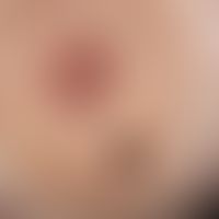 Usual melanocytic nevus. Brownish, roundish, 0.3 cm in diameter, sharply defined, soft, asymptoma...